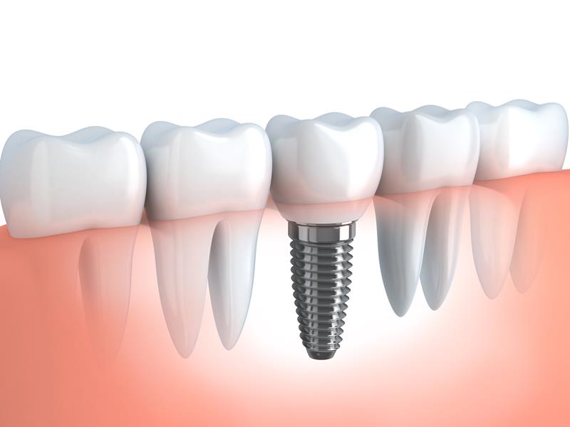 Dental Implants Waltham, MA