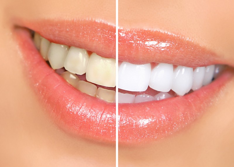 teeth whitening services Waltham, MA